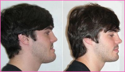 Did The Elvis Star Have Jawline Reconstruction Surgery and Nose Job? Fans Seek Before and After Pictures!
